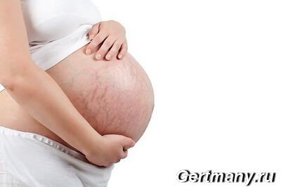 Предотвратить появление растяжек на теле в период беременности